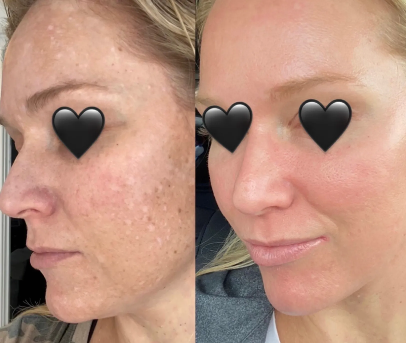 Cosmelan Professional Treatment